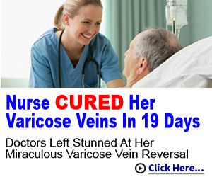 Varicose Veins Vanish