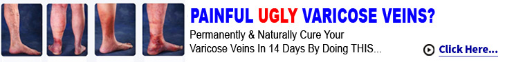 Varicose Veins Vanish